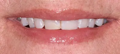 Patient with imperfect smile before cosmetic dentistry