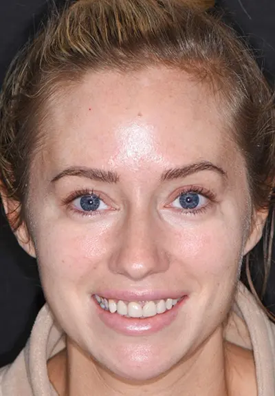 closeup of imperfect smile before cosmetic dentistry
