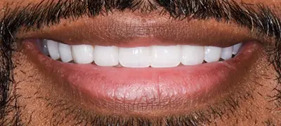 Patient with gorgeous smile after cosmetic dentistry