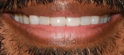 Patient with imperfect smile before cosmetic dentistry