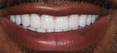 Patient with gorgeous smile after cosmetic dentistry