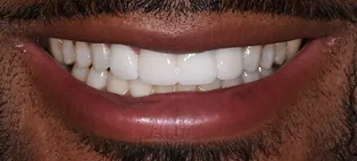 Patient with imperfect smile before cosmetic dentistry