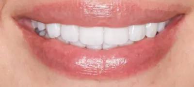 Patient with gorgeous smile after cosmetic dentistry