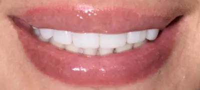 Patient with imperfect smile before cosmetic dentistry