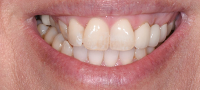 closeup of imperfect smile before cosmetic dentistry