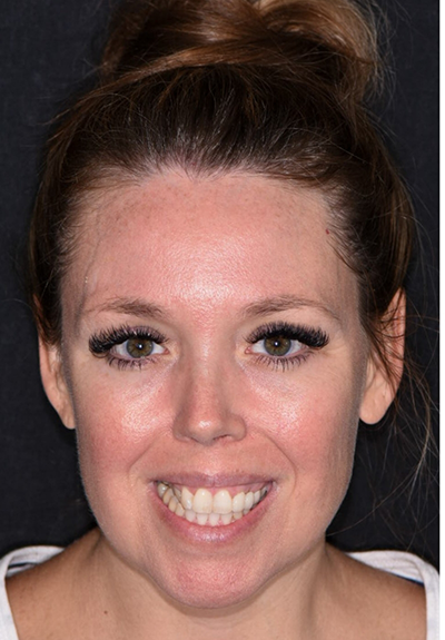Patient with imperfect smile before cosmetic dentistry