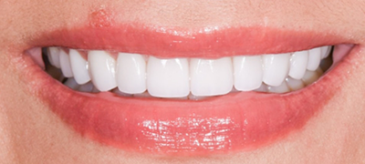 closeup of perfect smile after cosmetic dentistry