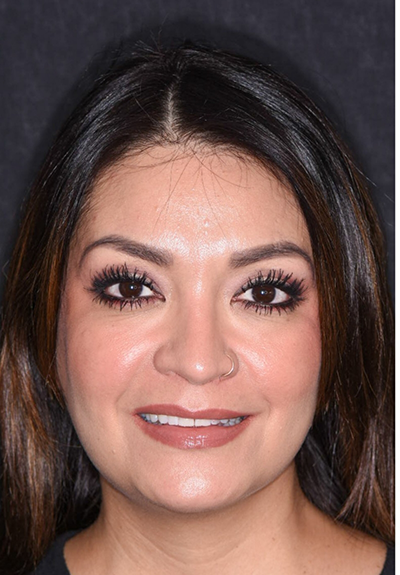 Patient with imperfect smile before cosmetic dentistry