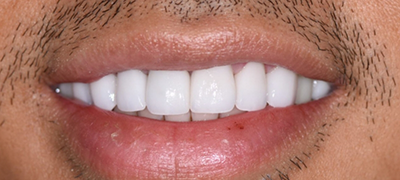 closeup of perfect smile after cosmetic dentistry