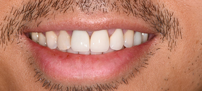 closeup of imperfect smile before cosmetic dentistry
