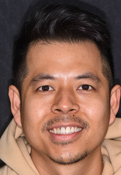 Patient with imperfect smile before cosmetic dentistry