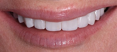 Closeup of brilliant smile after teeth whitening