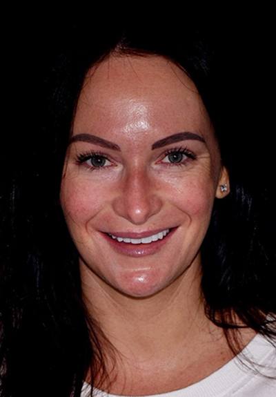 Patient with brilliant smile after teeth whitening