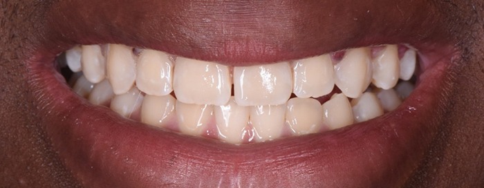 Close-up of smile after Icon treatment