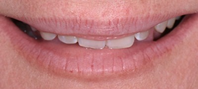 Closeup of yellowed smile before teeth whitening 