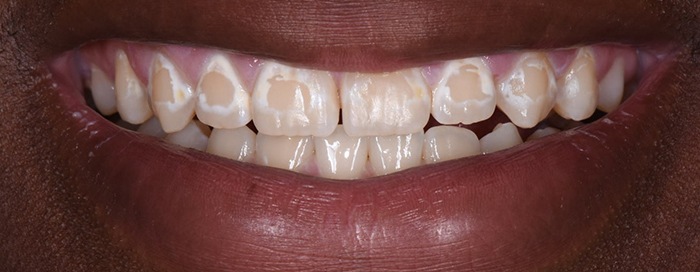 Close-up of smile before icon treatment in Frisco