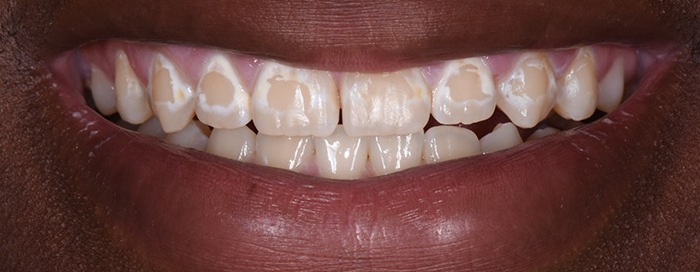 ICON: Treat Tooth Decay & Remove White Spots Without Drilling