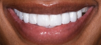 Closeup of brilliant smile after teeth whitening