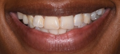 Closeup of yellowed smile before teeth whitening 