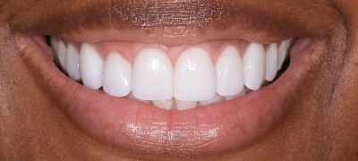 Closeup of brilliant smile after teeth whitening