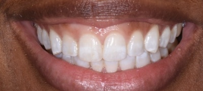 Closeup of yellowed smile before teeth whitening 