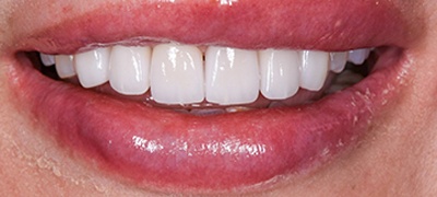 closeup of perfect smile after cosmetic dentistry