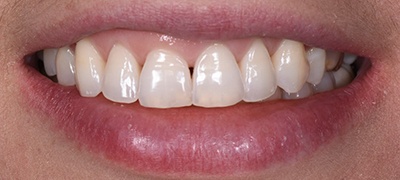 closeup of imperfect smile before cosmetic dentistry