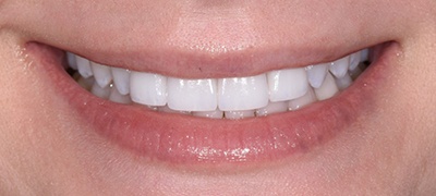 Brilliant white front teeth after teeth whitening