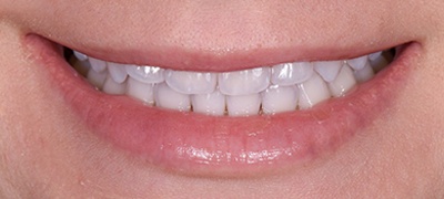 Yellow front teeth before teeth whitening