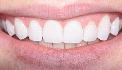 Closeup of brilliant smile after teeth whitening