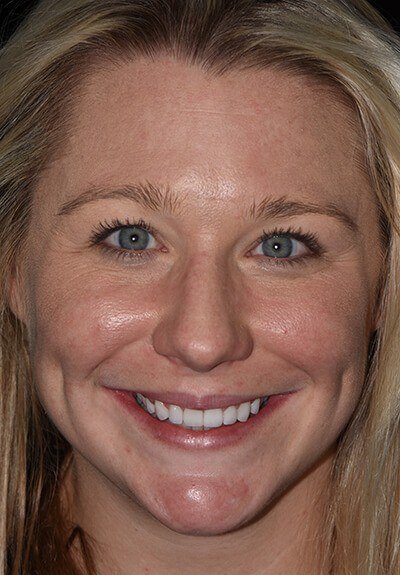 Patient with brilliant smile after teeth whitening