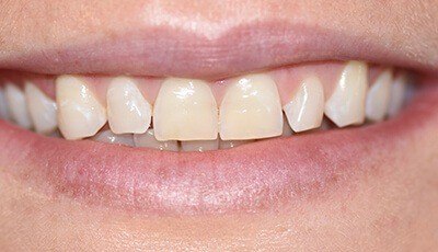 Closeup of yellowed smile before teeth whitening 