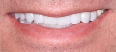 Closeup of brilliant smile after teeth whitening