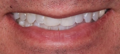 Closeup of yellowed smile before teeth whitening 