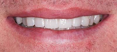 Closeup of perfectly aligned smile after clear braces orthodontics