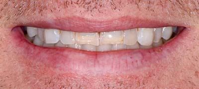 Closeup of smile with large gap between front teeth before clear braces orthodontics