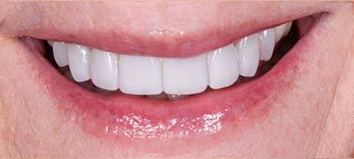 Closeup of perfectly aligned smile after clear braces orthodontics