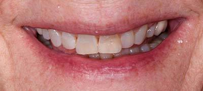 Closeup of smile with large gap between front teeth before clear braces orthodontics