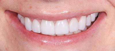 Closeup of perfectly aligned smile after clear braces orthodontics