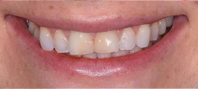 Closeup of smile with large gap between front teeth before clear braces orthodontics