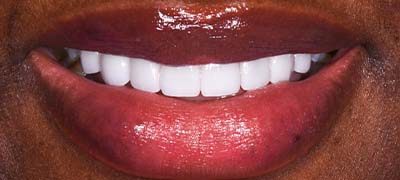 Closeup of perfectly aligned smile after clear braces orthodontics