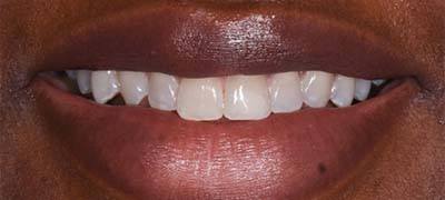 Closeup of smile with large gap between front teeth before clear braces orthodontics