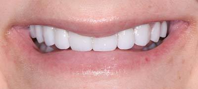 Closeup of perfectly aligned smile after clear braces orthodontics