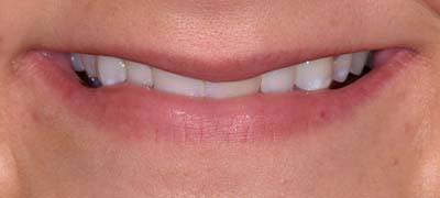 Closeup of smile with large gap between front teeth before clear braces orthodontics