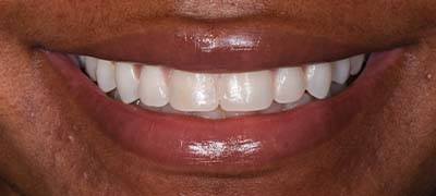Closeup of smile with large gap between front teeth before clear braces orthodontics