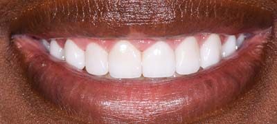 Closeup of perfectly aligned smile after clear braces orthodontics