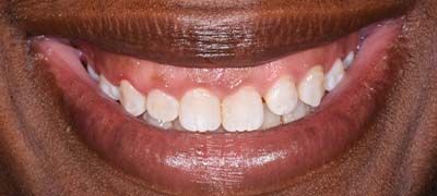 Closeup of smile with large gap between front teeth before clear braces orthodontics