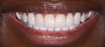 Closeup of perfectly aligned smile after clear braces orthodontics