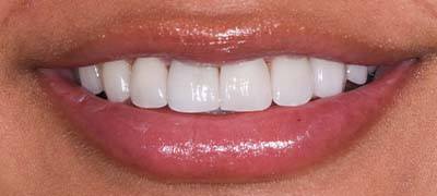 Closeup of perfectly aligned smile after clear braces orthodontics