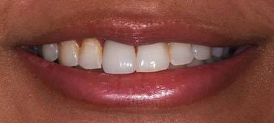 Closeup of smile with large gap between front teeth before clear braces orthodontics